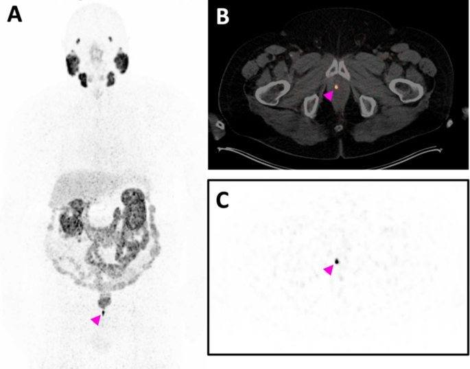 Zirconium-89-based PSMA PET/CT with delayed imaging for early detection of biochemical recurrence in prostate cancer patients with PSA ≤ 0.2 ng/mL: A feasibility study.的原文研究流程或关键结果图