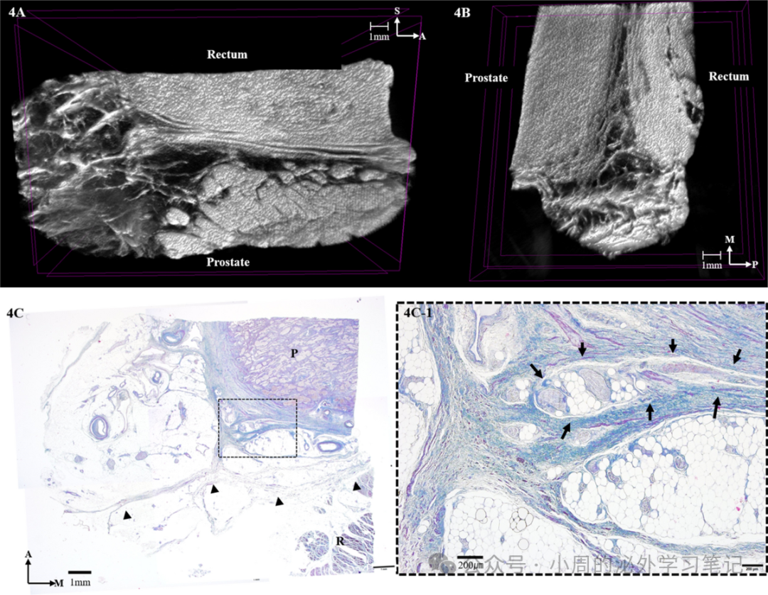图2 前列腺水平 Denonvilliers 筋膜、前列腺、直肠与神经血管束的 micro-CT/组织学关系。